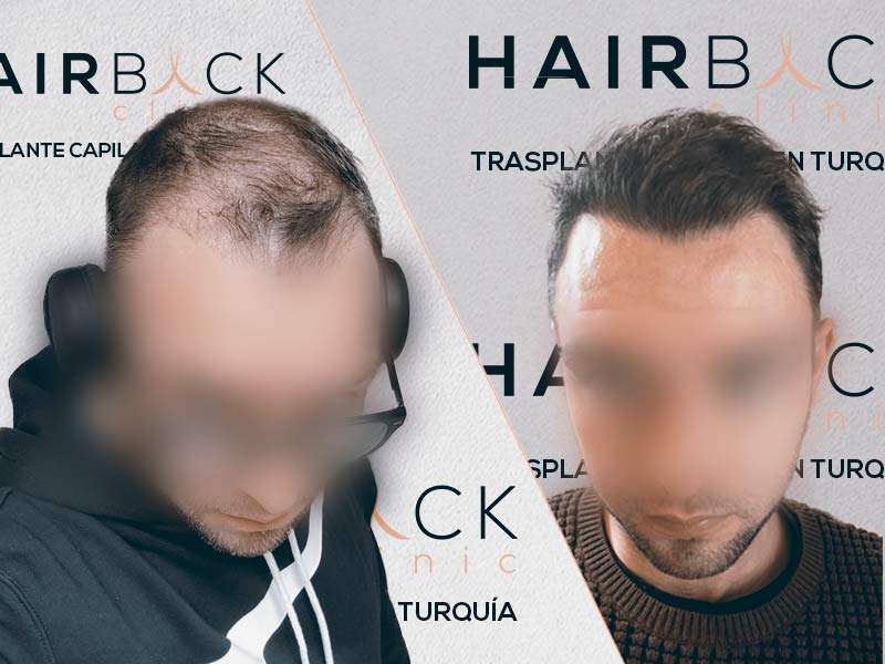 The Best Hair Transplant Clinics In Madrid