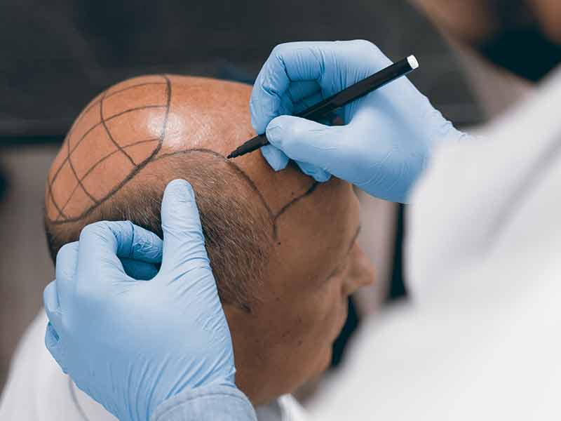 Second Hair Transplant: Is It Important?