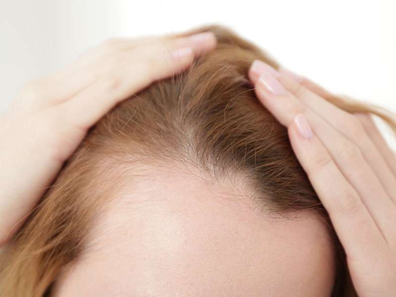 Stem cell treatment for female alopecia