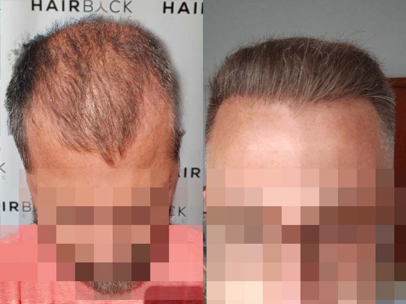 hair transplant istanbul results
