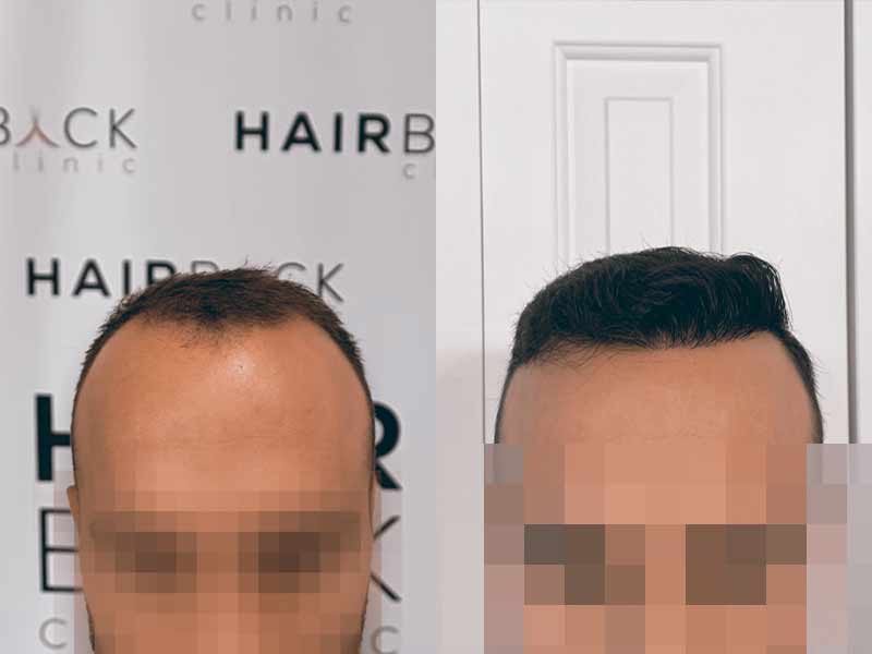 Hair transplant result Turkey