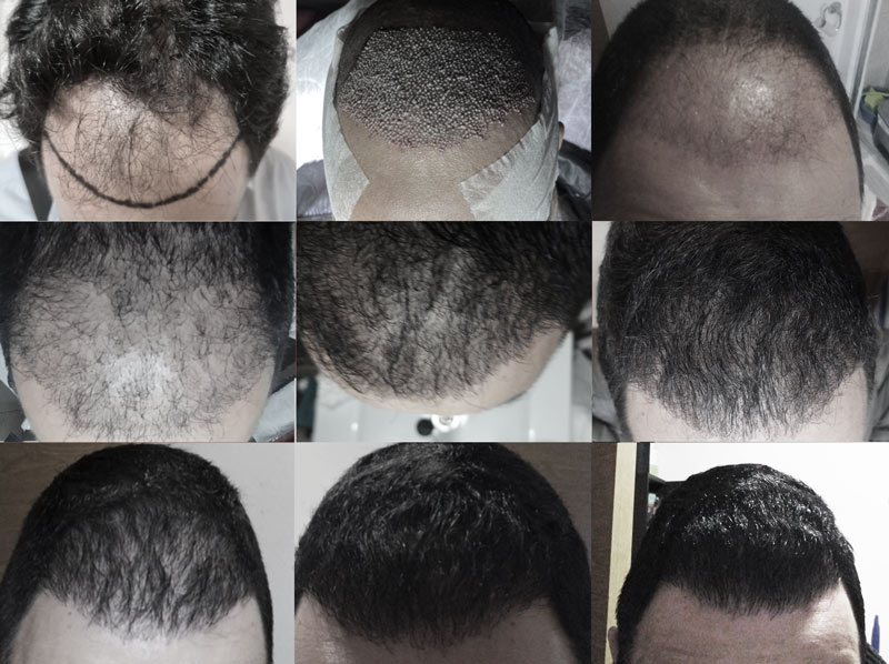 hair transplant result before after