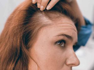 Alopecia in women