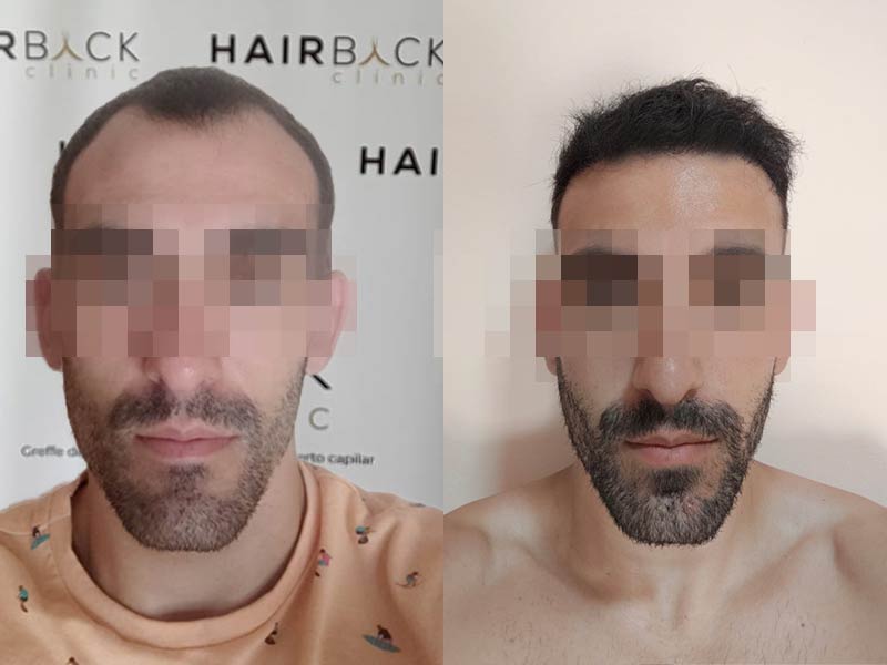 result after hair transplant 2023 turkey