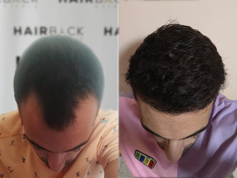 Hair transplant in Turkey Results after before