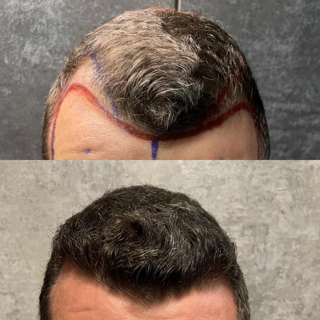 Hair transplant in Turkey Results after before