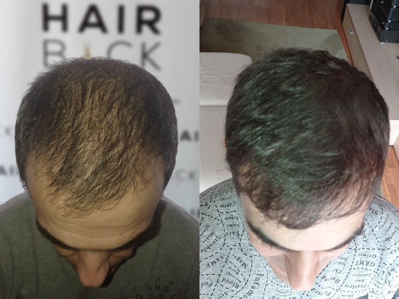 Result hair transplant in Turkey before after