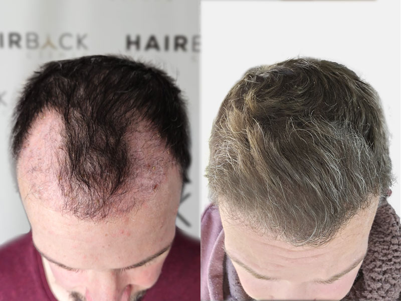 Result hair transplant in Turkey before after