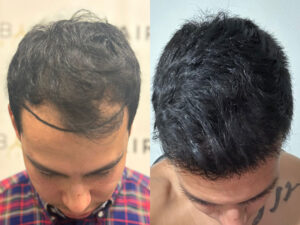 Result hair transplant in Turkey before after