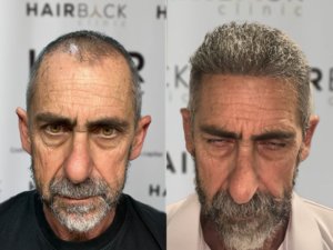 Result hair transplant in Turkey before after