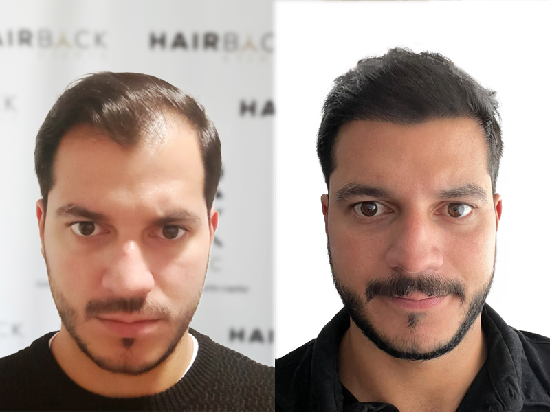 Result hair transplant in Turkey before after