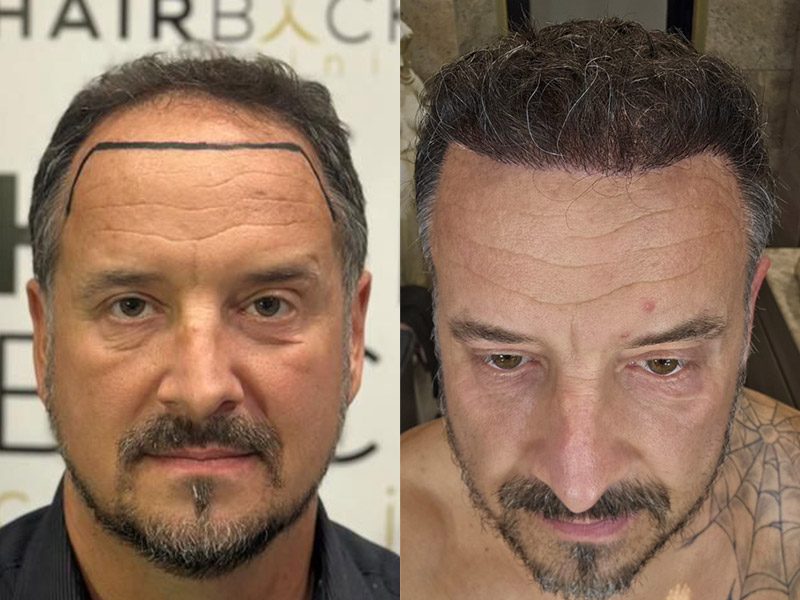 Result hair transplant in Turkey before after