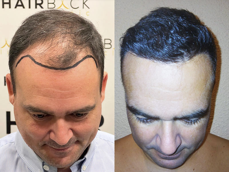 Result hair transplant in Turkey before after