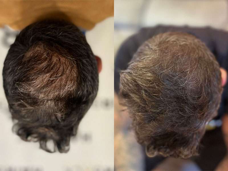 Hair Transplant Cost in Turkey