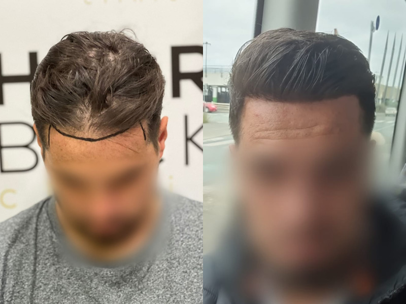 Result hair transplant in Turkey before after