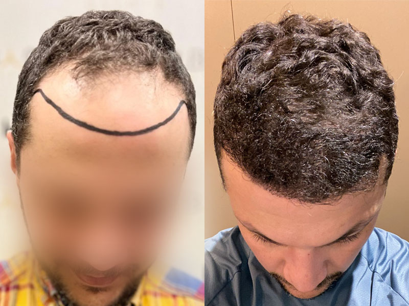 Result hair transplant in Turkey before after