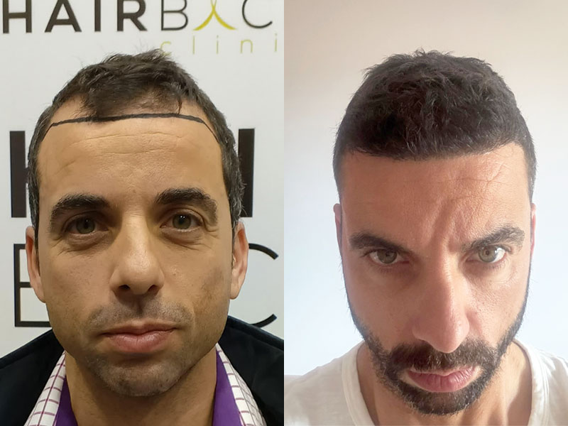 hair transplant in turkey